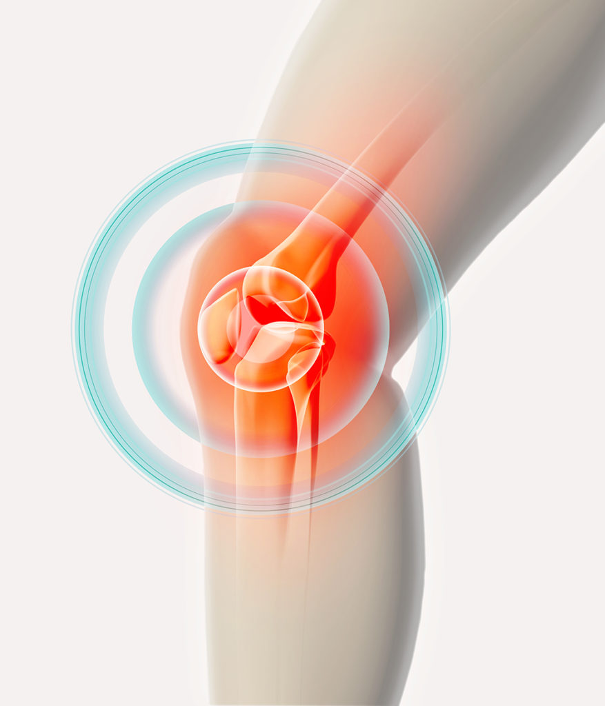 új technológiák az artrózis kezelésében a borjúízületek fájdalmainak gyengesége